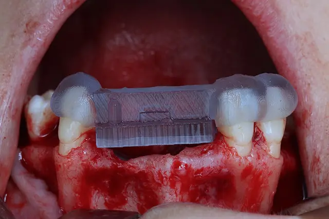reconstrucción ósea dental guiada